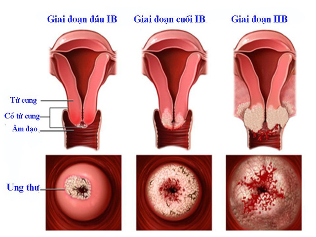 Ảnh 3 của Cervical cancer